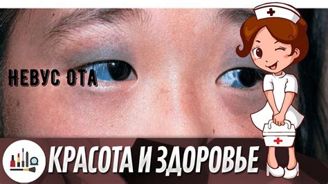 Невус Ота - YouTube