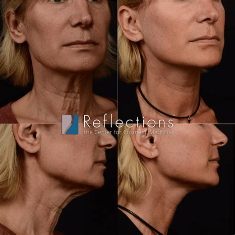 how to fix loose skin under chin