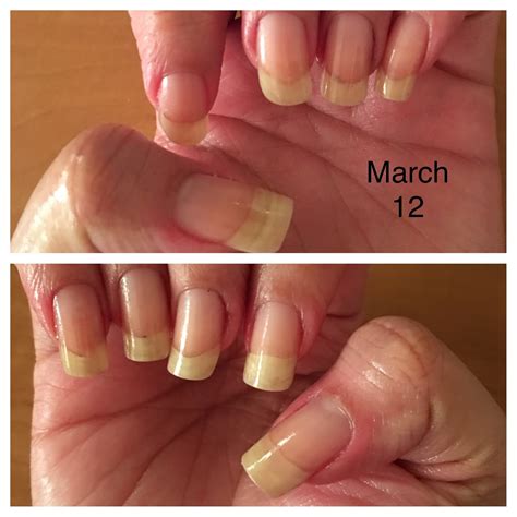 How to Save and Regrow Nails After a Break