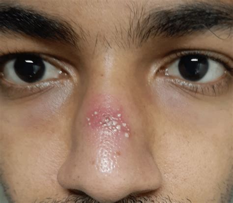 Crops of pustules with background erythema over dorsum of nose ...