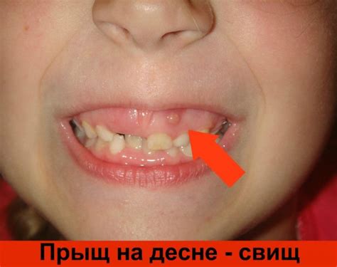 Язвочки во рту у ребенка причины и лечение фото