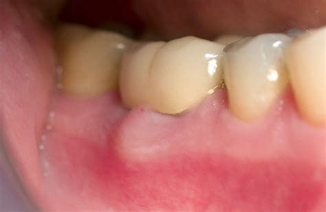 Gingival abscess - Definition of Gingival abscess