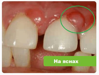 Гранулема зуба, Симптоми, Фото, Діагностика