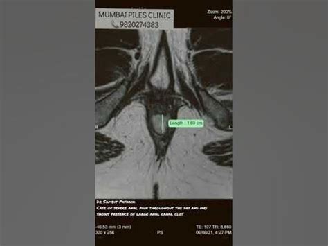mri image  painful anal clot youtube