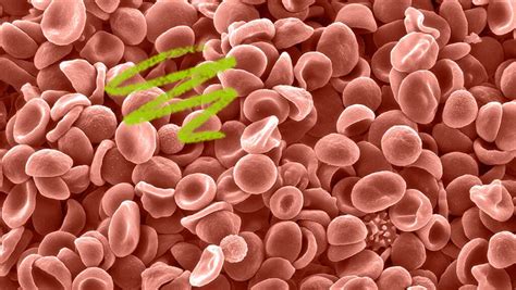 Thrombocytopenia platelet count range: Severe, moderate, and mild