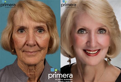 chemical face peel before and after 9