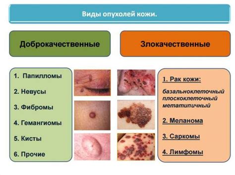 Доброкачественные новообразования кожи: классификация и виды