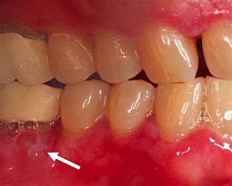 cicatricial pemphigoid gums