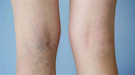 Como Tirar Roxo Da Perna - Manchas roxas nas pernas, do nada, após treino: o que causa? – Saúde ...