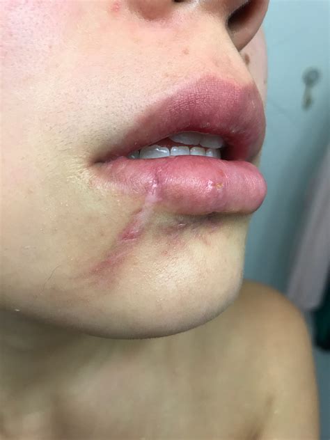 How Do Dog Bites Heal