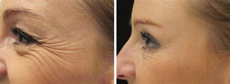 Vrásky a tekutý lifting - Botulotoxin | Esthé Laser Clinic