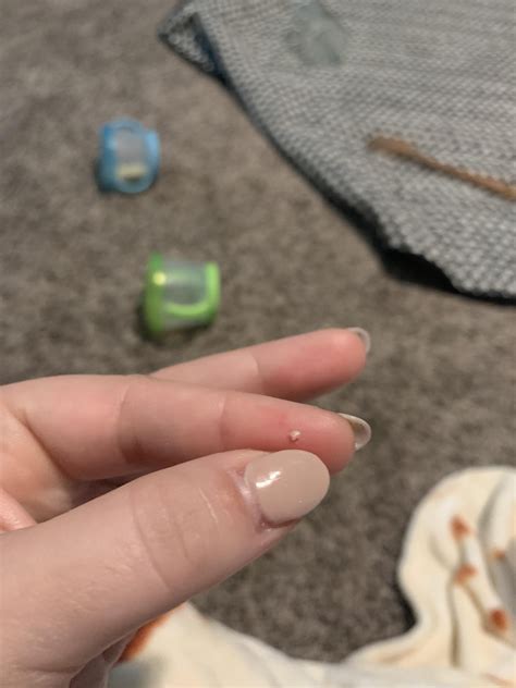 This little guy came out the top of my toe!! : r/Ingrown_Toenails