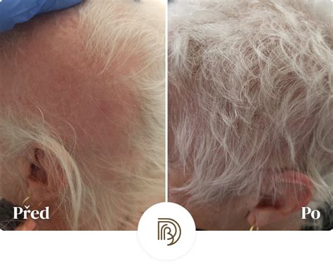 Dr. Brabcová - léčba alopecie a vypadávání vlasů