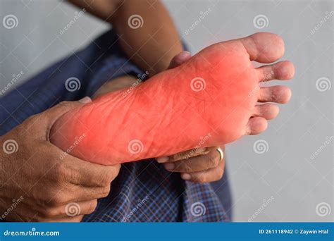 Tingling And Burning Sensation In Foot Of Asian Man. Foot Pain. Sensory ...