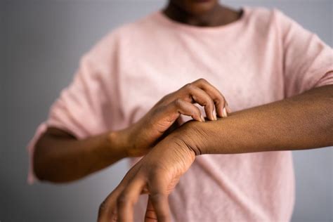 Dyshidrotic Eczema: Symptoms, Causes, Treatment, & More