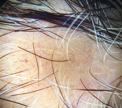 Dermoscopy of alopecia areata-a retrospective analysis. - Abstract ...