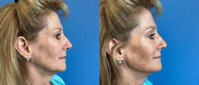 Jawline Contouring Before & After Photos | CosmetiCare