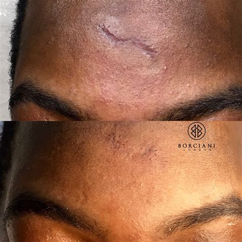 How do scars heal over long periods of time on brown skin? : r/NoStupidQuestions