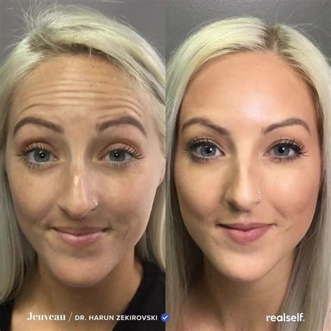 Differences between botox dysport xeomin jeuveau – Artofit