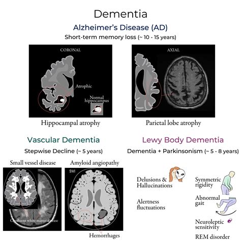 Neurological System Glossary: Dementia | ditki medical & biological