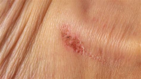 Impetigo: Symptoms, Causes, Treatments - Clear Skin Clinic