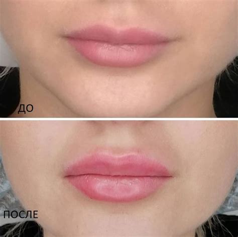 Губы | Косметология New Way clinic Москва