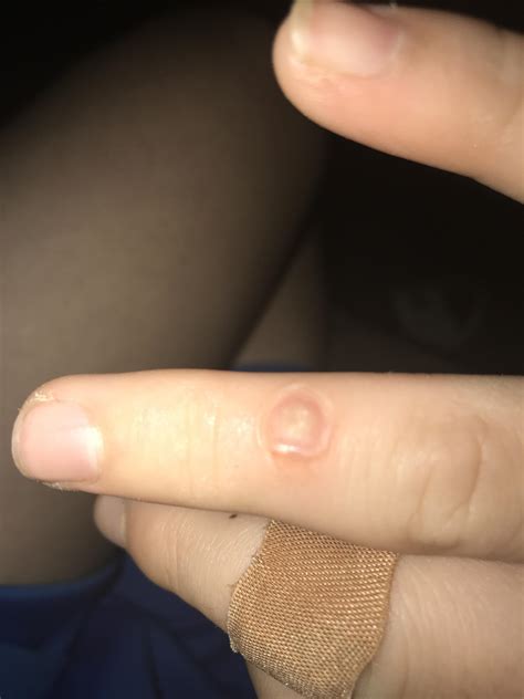 Popped my blood blister with a hot needle and tequila would not