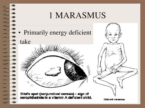 protein energy malnutrition powerpoint
