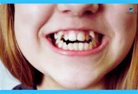 kid   rows  teeth heres  experts