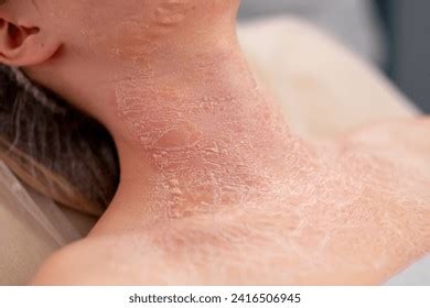 Crusting Skin Rash: Over 479 Royalty-Free Licensable Stock Photos ...