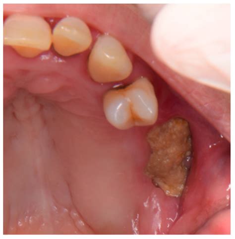Bisphosphonates Osteonecrosis