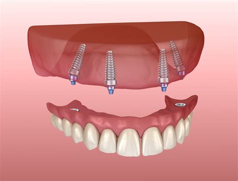 implant retained denture 2 - Denton Dental Center Blog