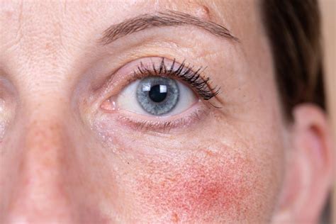 rosacea   dose
