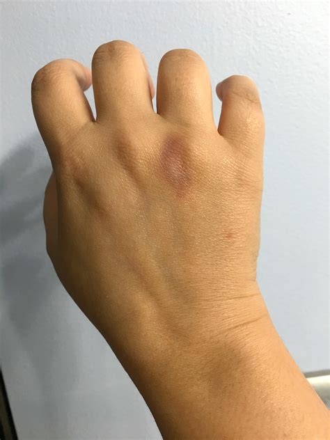 Ruptured Tendon? You guys ever have bruising like this?? This happened