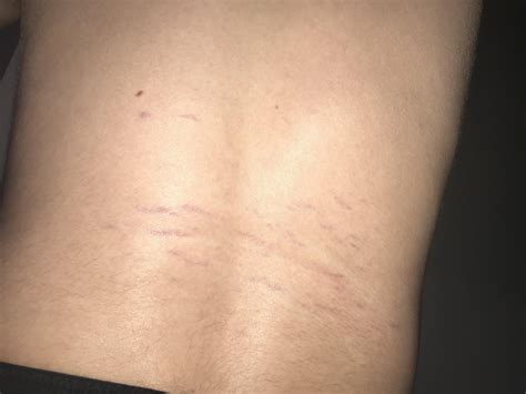 Back bruising? : r/medical