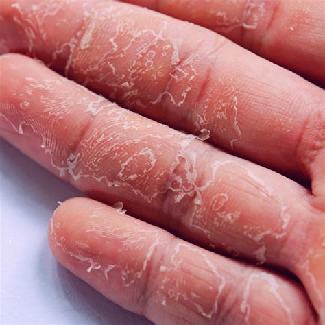 skin peeling  fingertips archives oliva skin hair care clinics