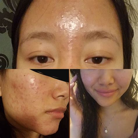 Please help me. The bottom right picture was my face 4 days ago. I woke