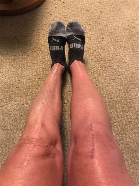 Baker's Cyst Thigh at Louise Costa blog