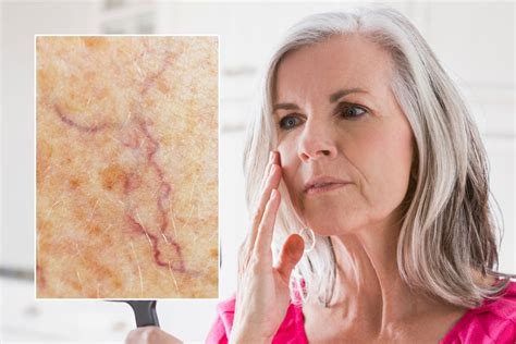 Spider veins: What to eat, put on your face, and wear to reduce their ...