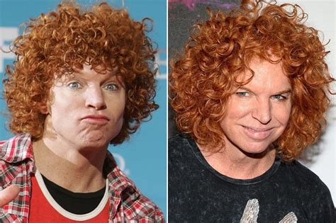 Scott Thompson «Carrot Top» Before and After Plastic Surgery: Facelift