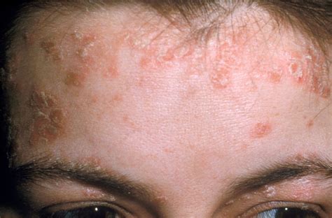Seborrhoisches Ekzem (seborrhoische Dermatitis) | Apotheken Umschau