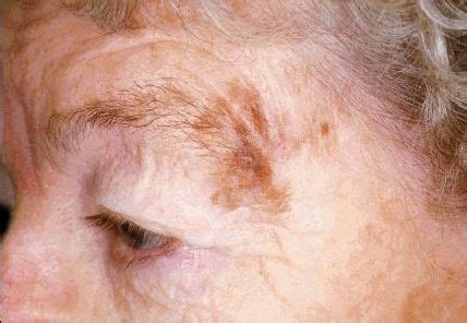 Рак кожи лица фото – 33 шт. / fotodiagnoz.com