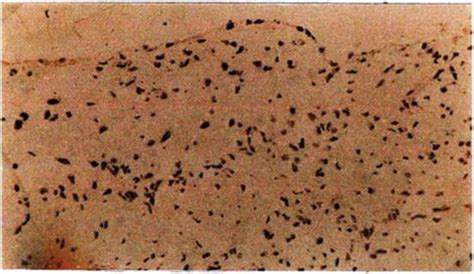 Etiology and Pathogenesis of Buerger’s Disease | IntechOpen