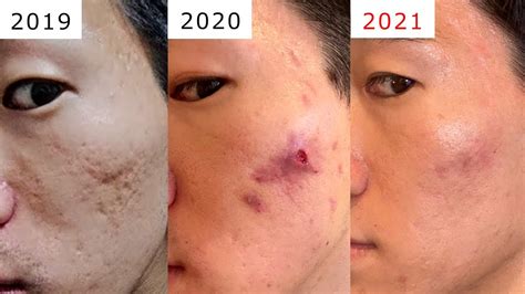 acne scarring