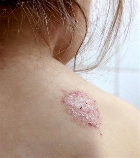 Discoid Eczema: Symptoms, Causes, How To Treat, & Prevention