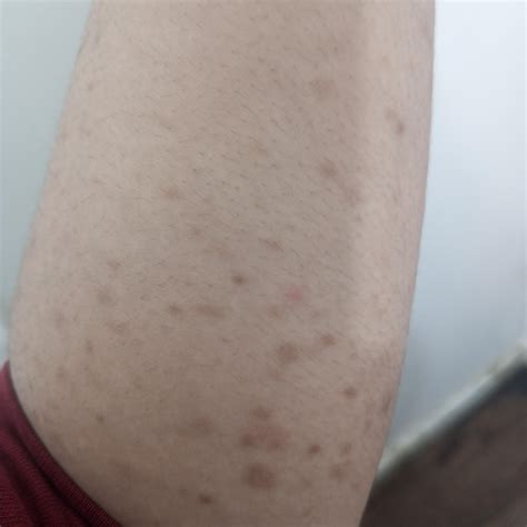 I have Urticaria Pigmentosa. : r/urticaria