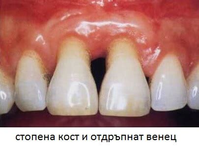 Пародонтит - пародонтоза | Дентално Студио BemyDent