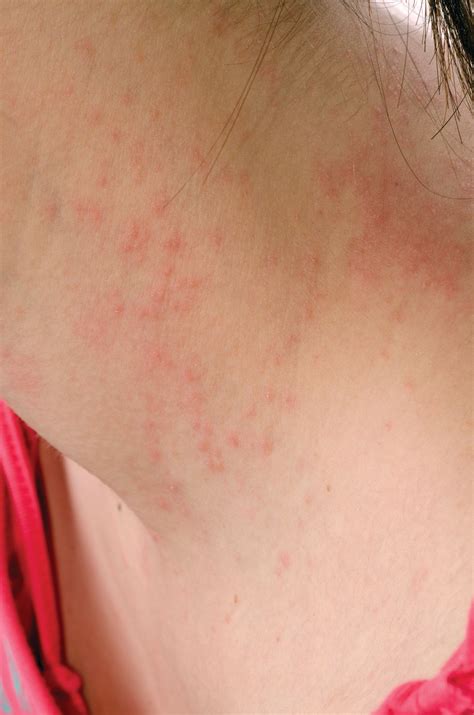 Dermatitis Rash On Arms