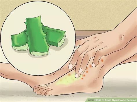 How to treat dyshidrotic eczema 8 effective home remedies – Artofit