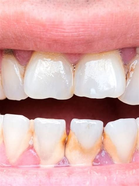 primary factors leading  exposed dentin